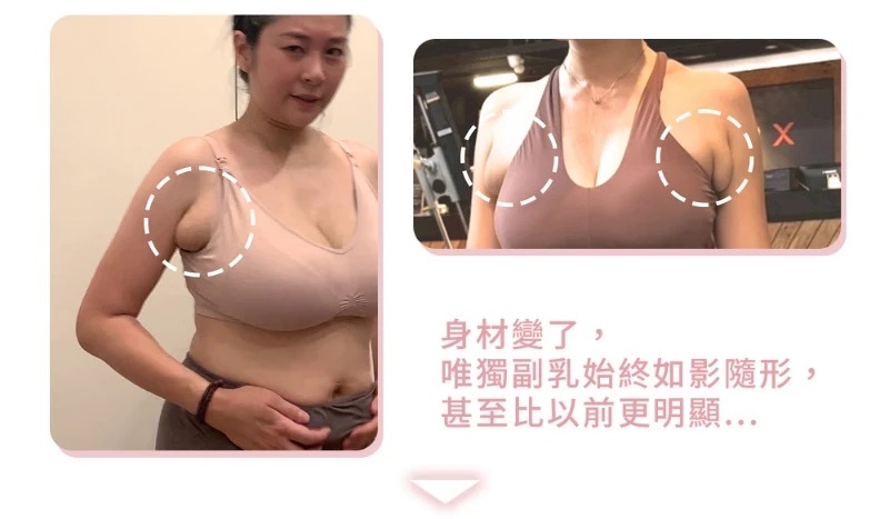 副乳嚴重案例綺綺術前生活困擾