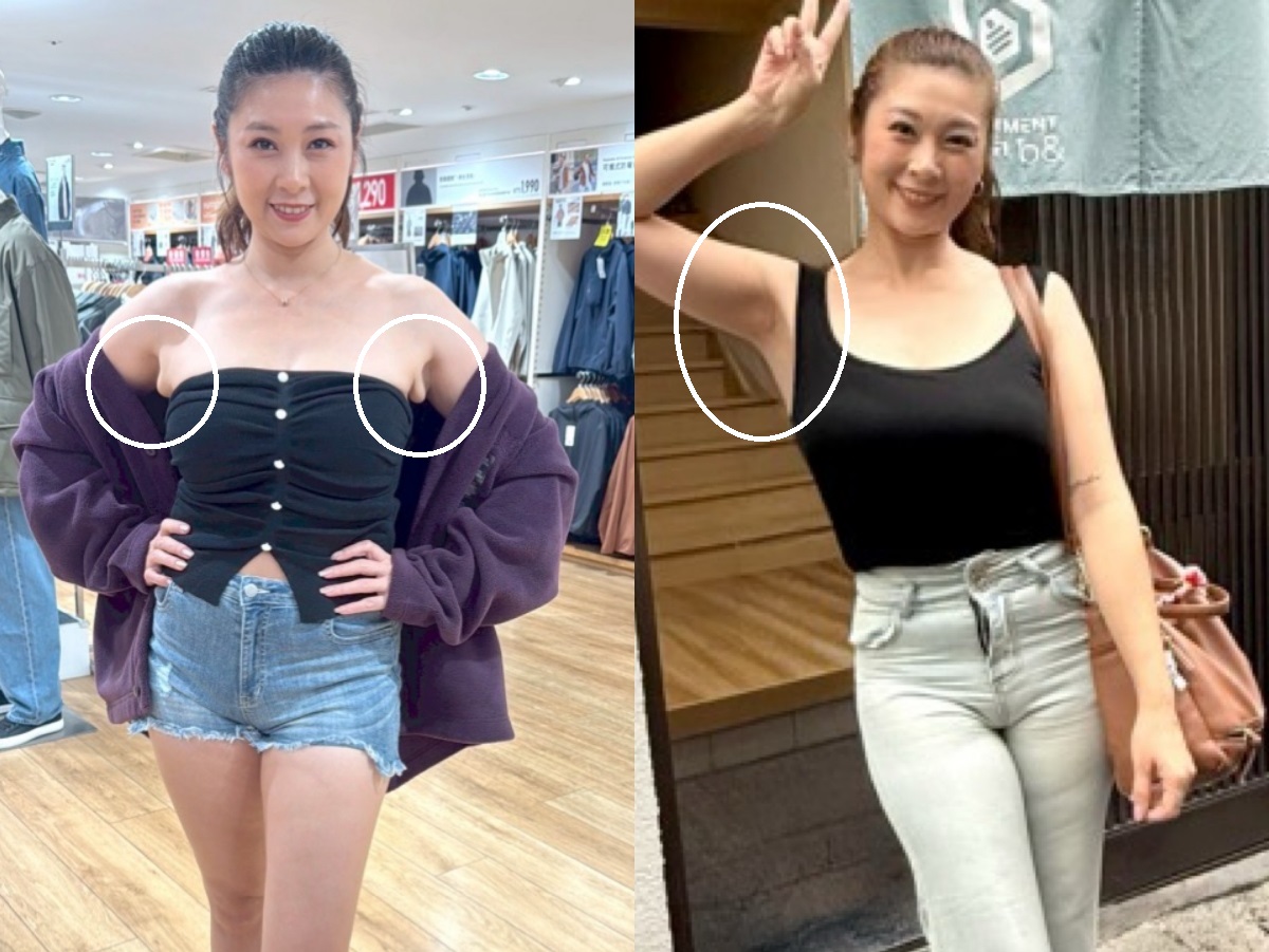 副乳嚴重顯微套管術前術後對比