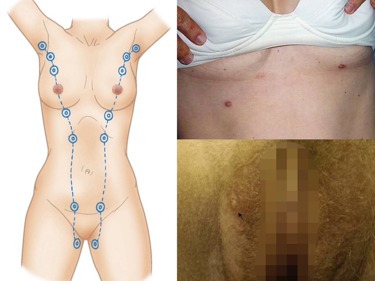 副乳頭位置分布圖解說明