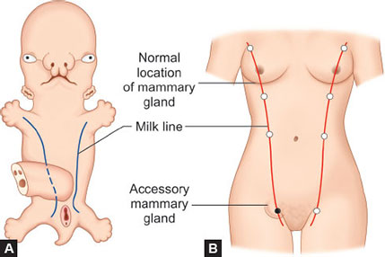 副乳頭是什麼與成因說明