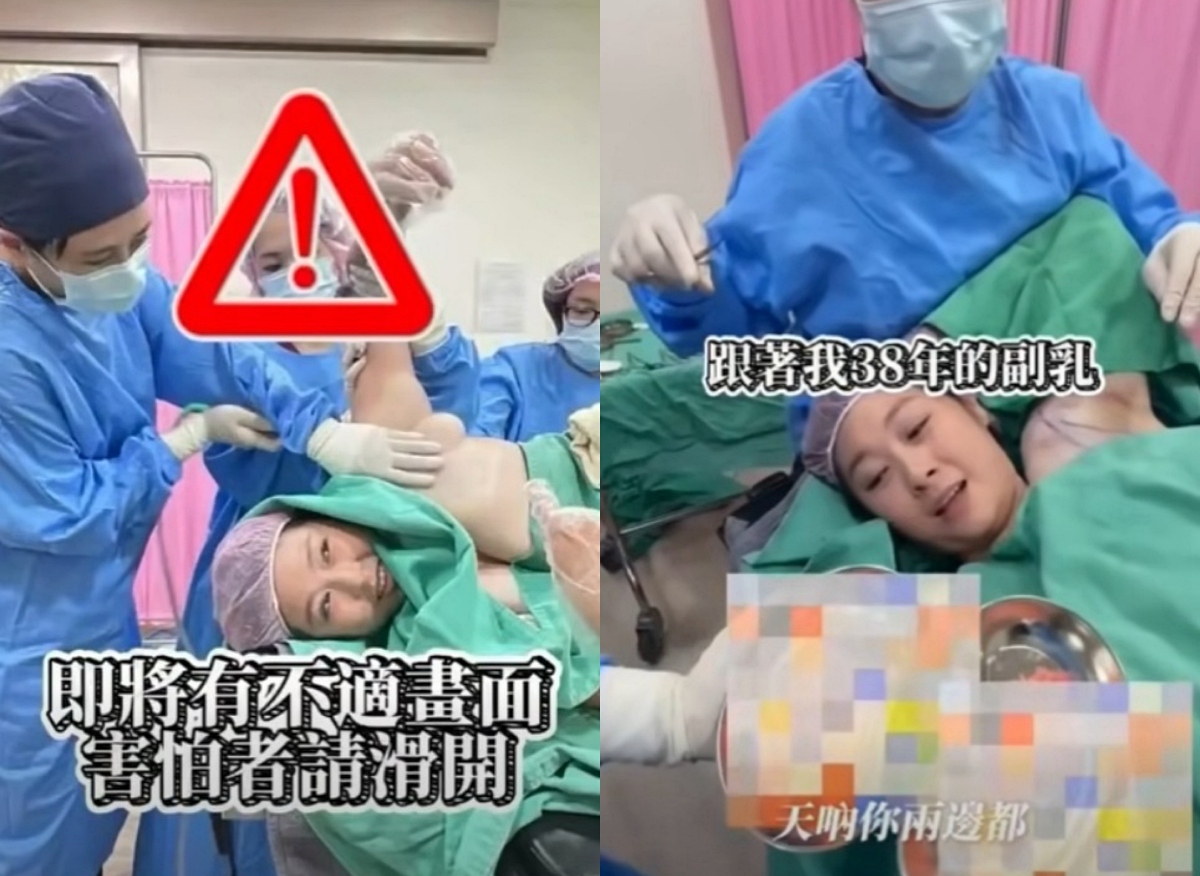 點擊觀看副乳嚴重改善短影音分享
