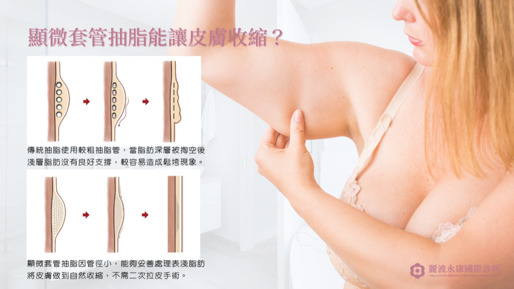 顯微套管細徑管徑優勢