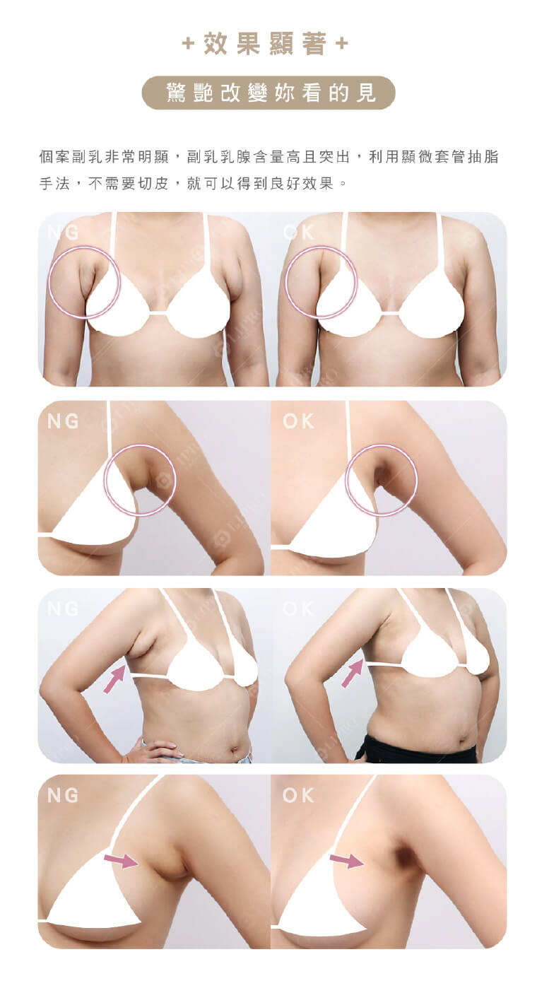 副乳怎麼消,快速消副乳dcard,副乳按摩,副乳運動,副乳內衣,副乳怎麼消dcard
