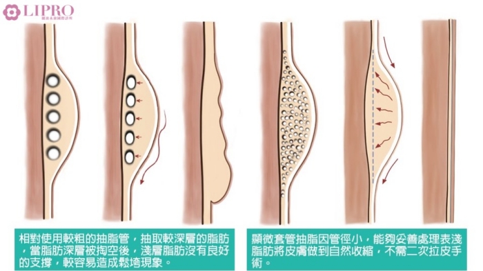 抽脂後皮膚鬆弛,抽脂後遺症,抽脂皮鬆,抽脂失敗