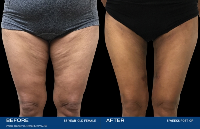 減肥後皮膚鬆弛怎麼辦?體雕缺點