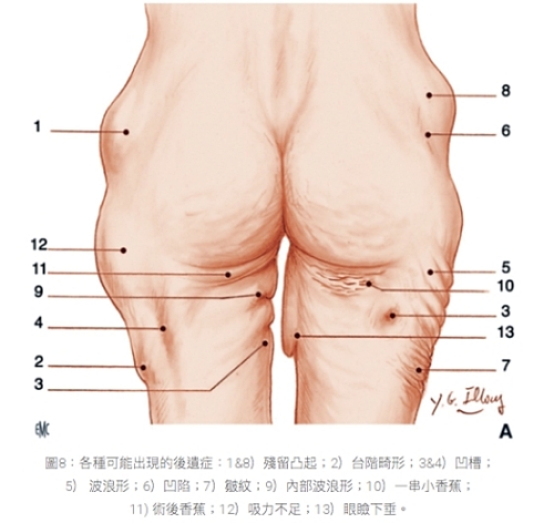 抽脂後遺症ptt,抽脂後遺症,大腿抽脂後遺症,麗波永康國際診所