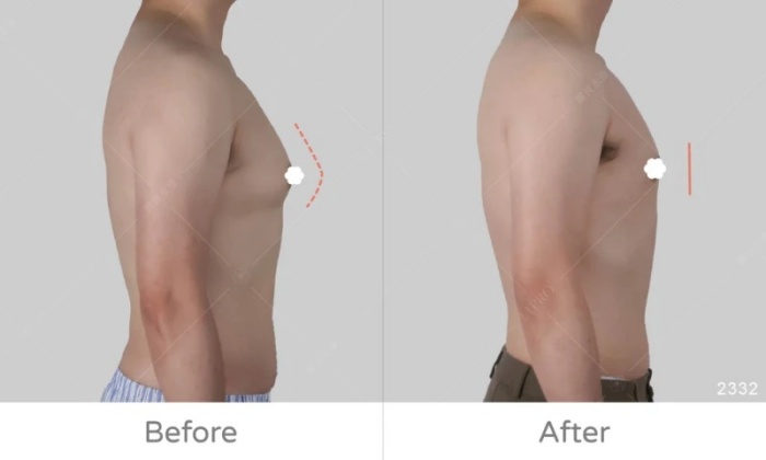 激凸,男生激凸的原因,激凸怎麼辦,怎麼消除激凸