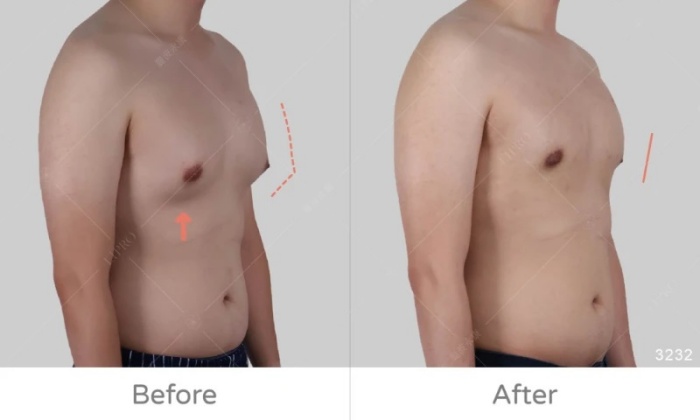 激凸,男生激凸的原因,激凸怎麼辦,怎麼消除激凸