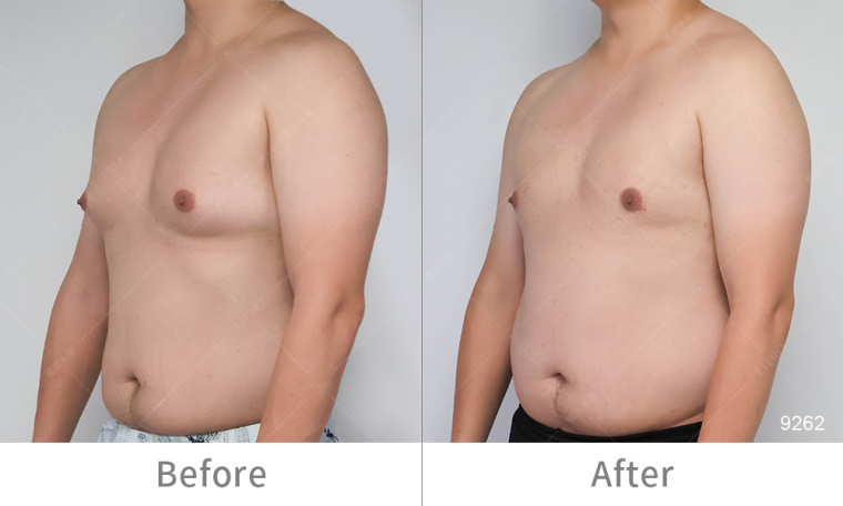 男性副乳合併女乳症抽脂雕塑3