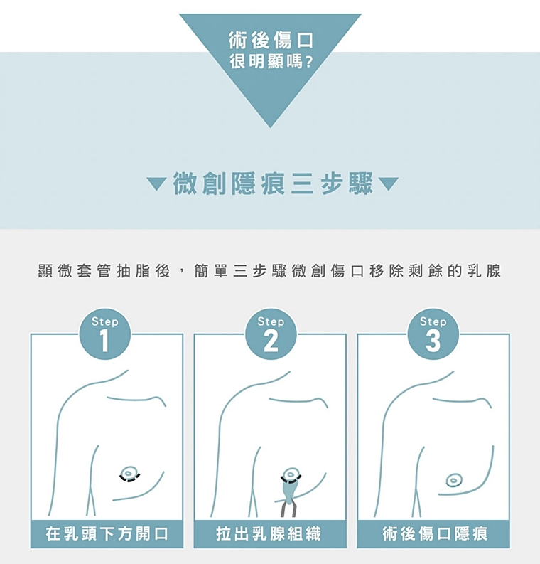 男性女乳症手術過程說明