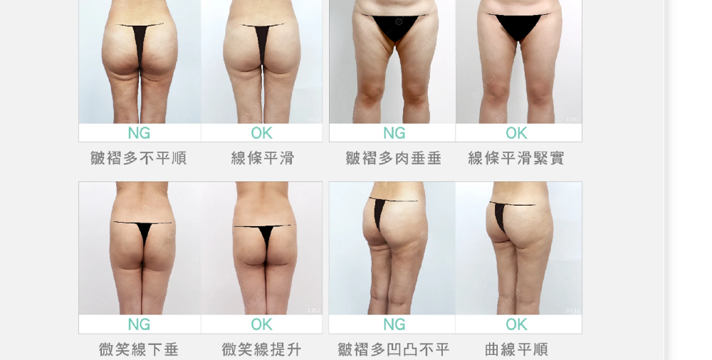 臀腿抽脂,專家拆解下半身肥胖原因,下半身肥胖,如何改善下半身肥胖