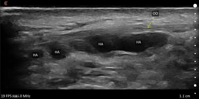 饅化怎麼辦,饅化修復,饅化原因,超音波饅化臉