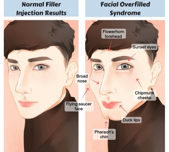 饅化怎麼辦,饅化修復,饅化原因,超音波饅化臉
