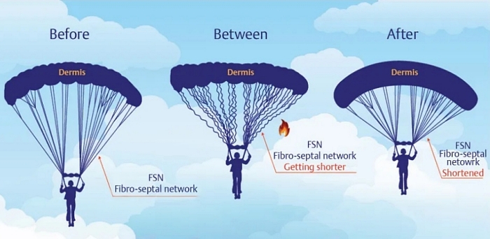 墨菲斯電波修復期,墨菲斯電波術後,麗波永康國際診所