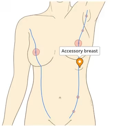 為什麼會有副乳,副乳長怎樣,副乳運動有用嗎