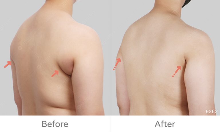 為什麼會有副乳,副乳長怎樣,副乳運動有用嗎