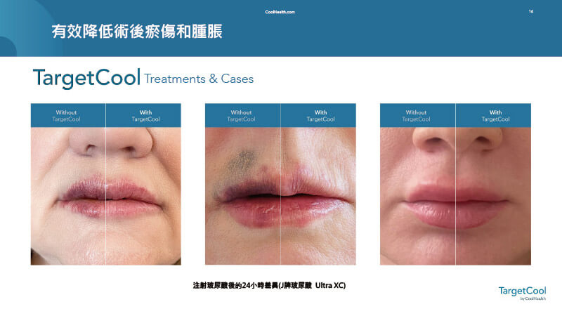 三組唇部的療程前後對照圖，顯示使用TargetCool可有效降低術後瘀青與腫脹現象