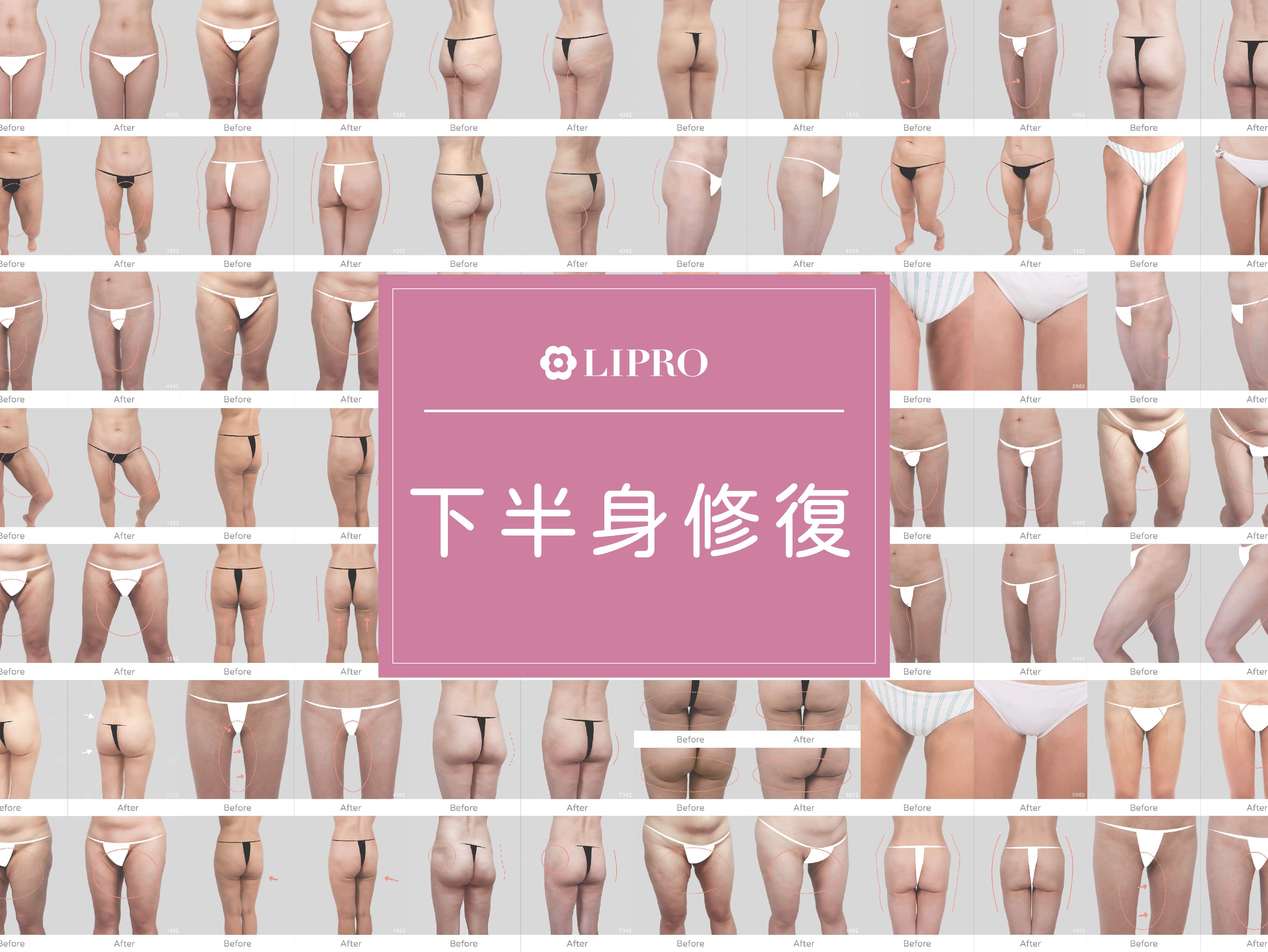 抽脂後遺症ptt,抽脂後遺症,大腿抽脂後遺症,麗波永康國際診所