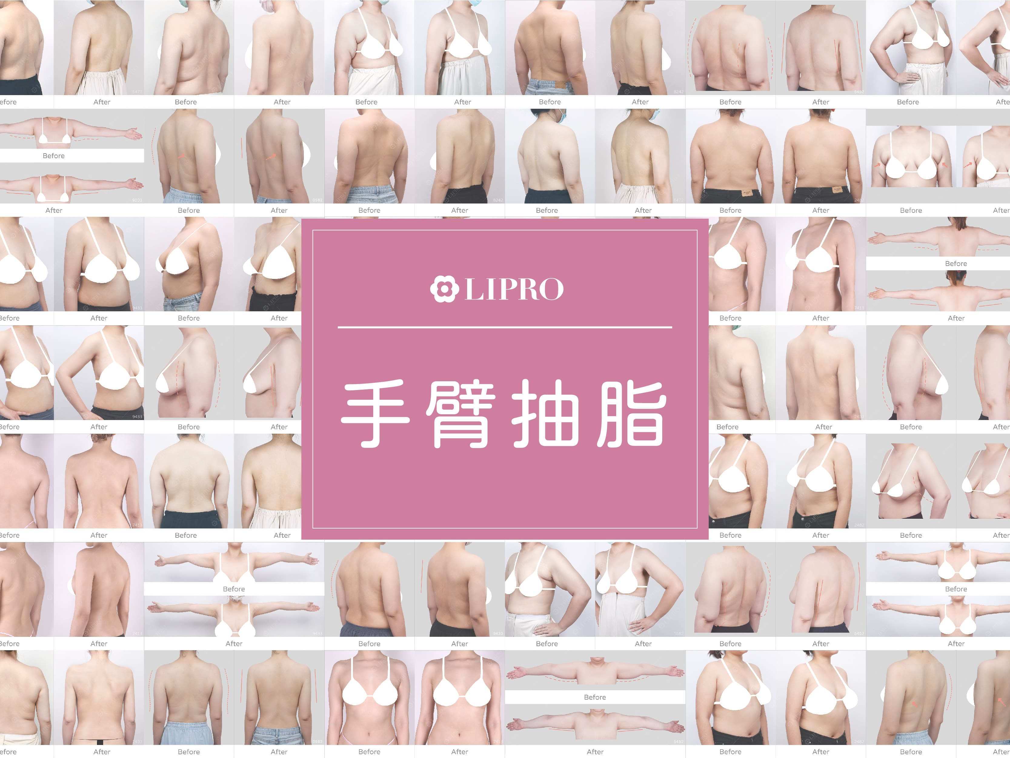 顯微套管抽脂,顯微套管抽脂dcard,顯微套管抽脂術後,顯微套管抽脂費用