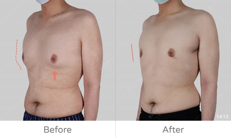 男性女乳症手術dcard,男性女乳症塑身衣要穿多久