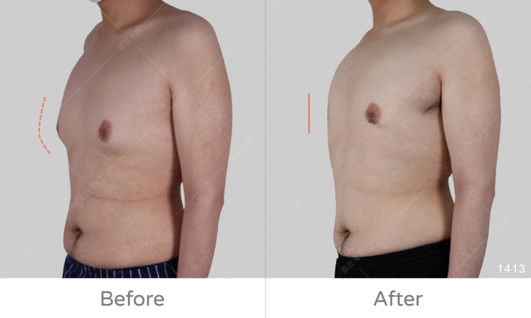 男性女乳症手術dcard,男性女乳症塑身衣要穿多久