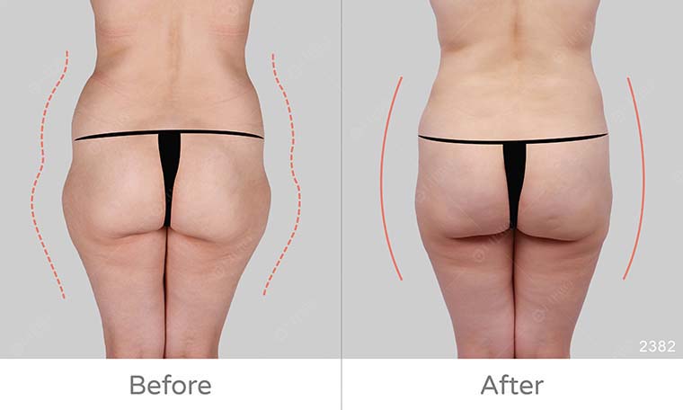 屁股兩側凹陷原因,屁股大怎麼消,麗波永康國際診所