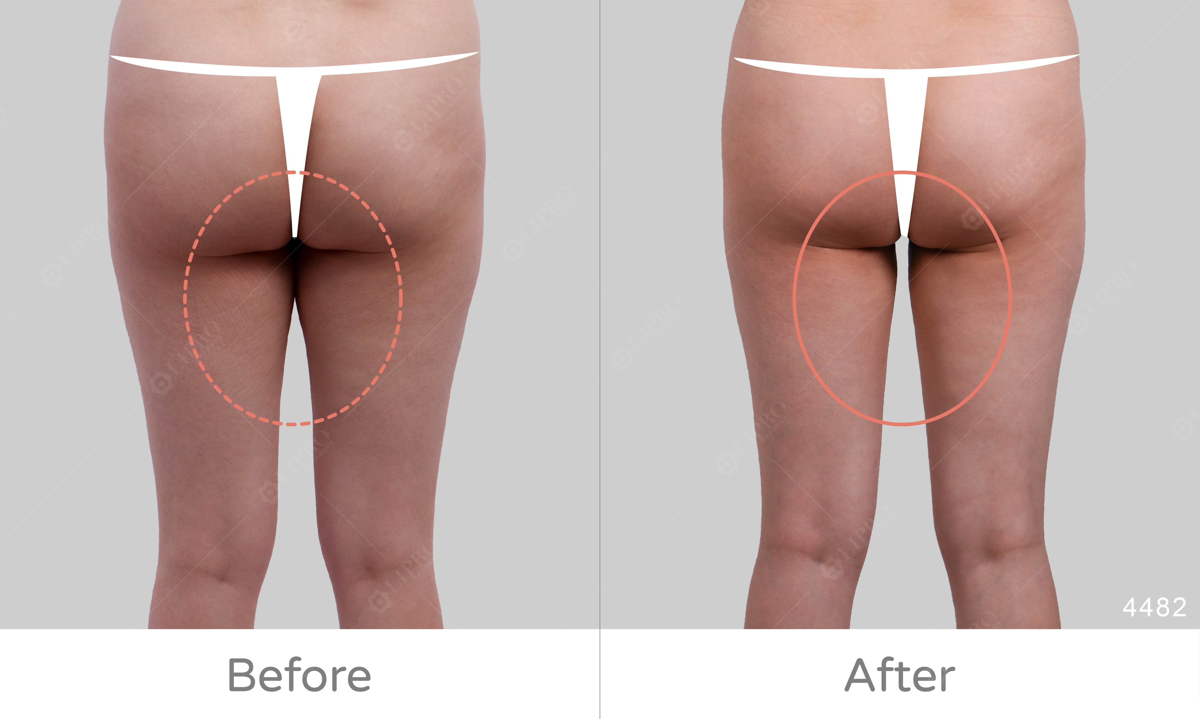 屁股兩側凹陷原因,屁股大怎麼消,麗波永康國際診所