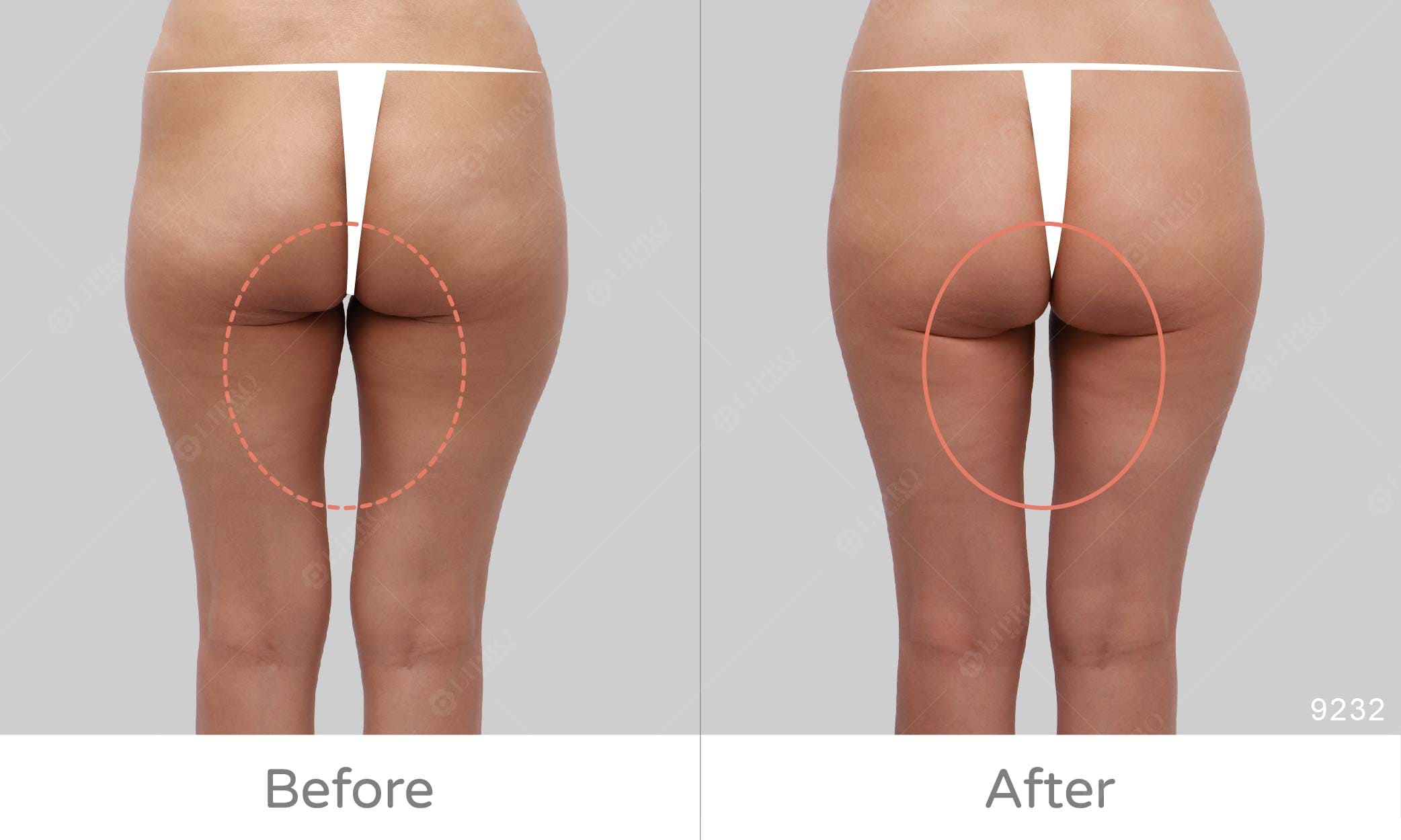 屁股兩側凹陷原因,屁股大怎麼消,麗波永康國際診所