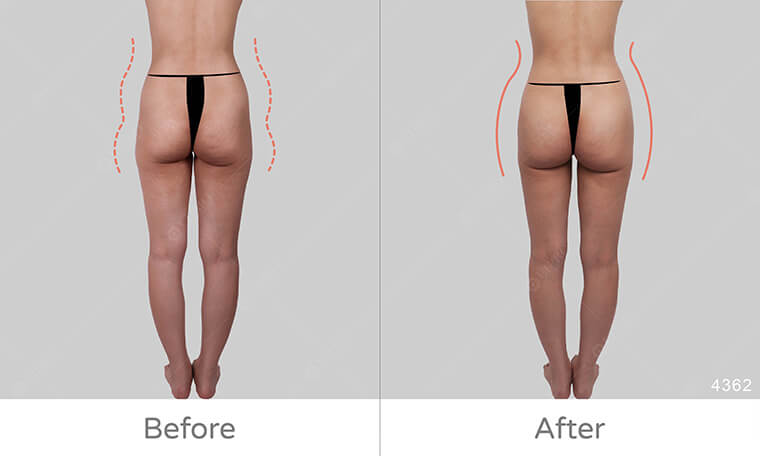 屁股兩側凹陷原因,屁股大怎麼消,麗波永康國際診所