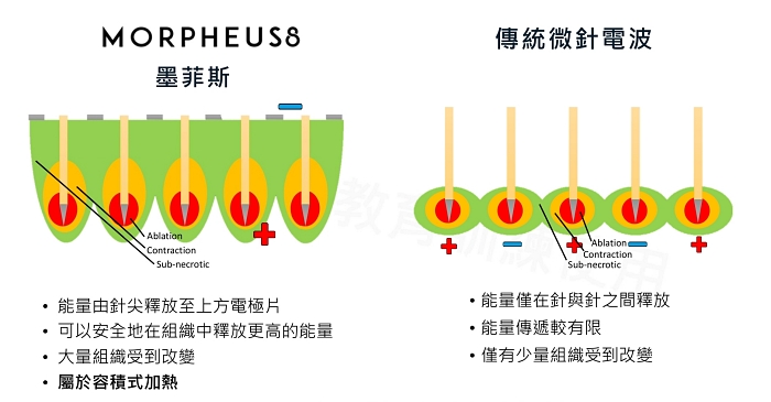 墨菲斯電波修復期,墨菲斯電波術後,麗波永康國際診所