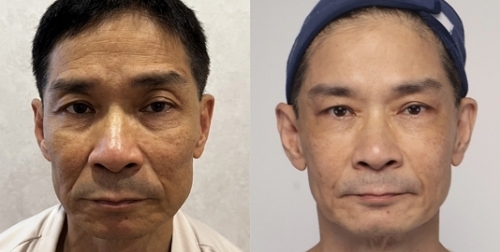 墨菲斯電波修復期,墨菲斯電波術後,麗波永康國際診所