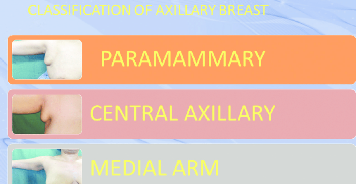 為什麼會有副乳,副乳長怎樣,副乳運動有用嗎