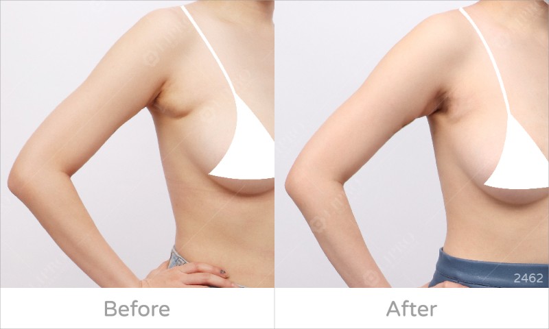 為什麼會有副乳,副乳長怎樣,副乳運動有用嗎