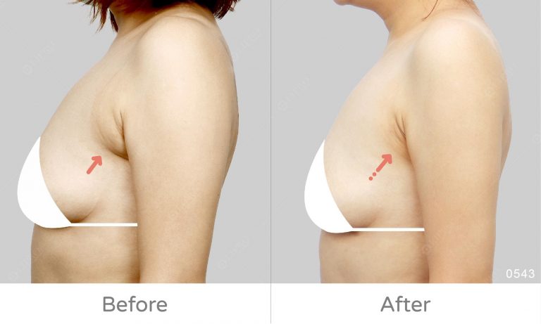 為什麼會有副乳,副乳長怎樣,副乳運動有用嗎