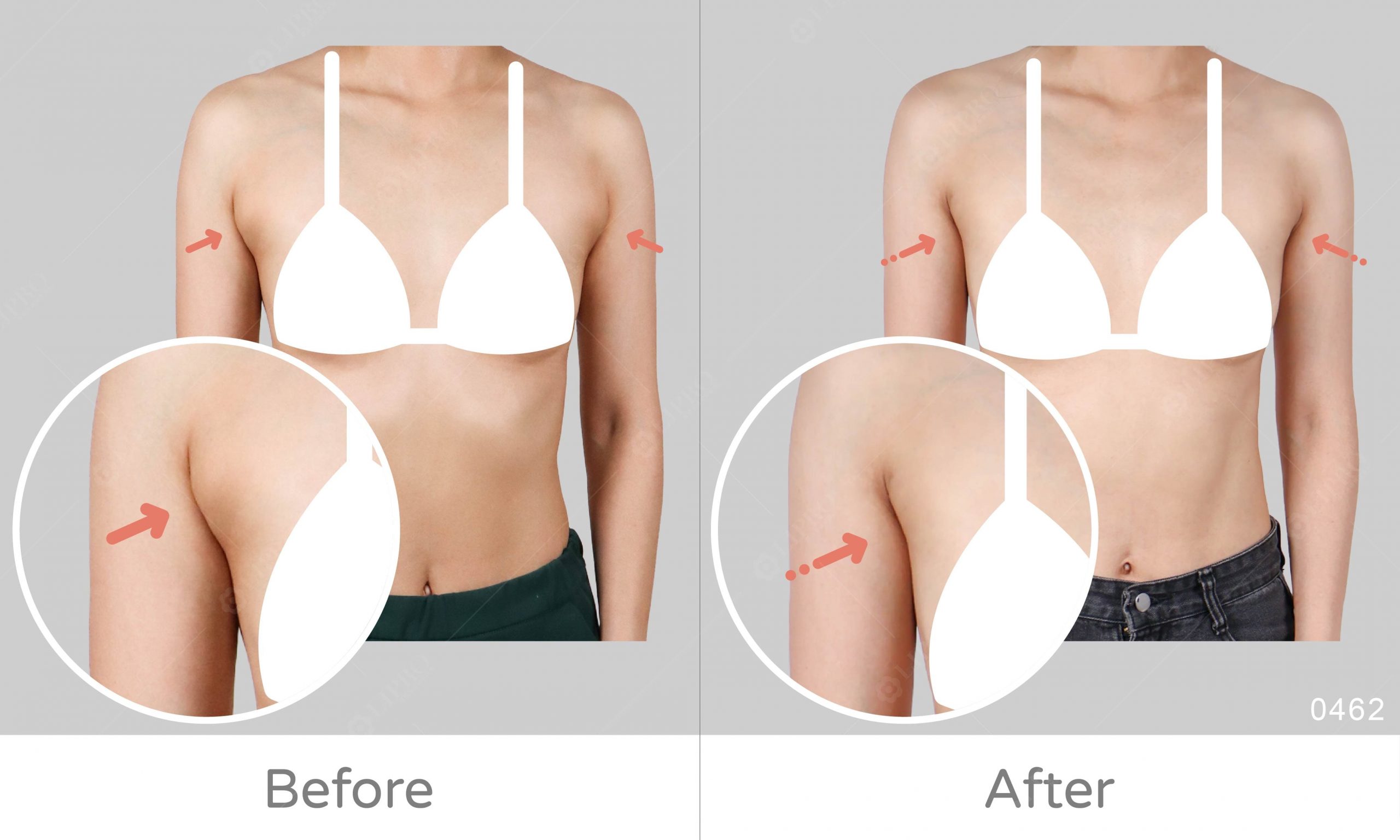 副乳怎麼消,快速消副乳dcard,副乳按摩,副乳運動,副乳內衣,副乳怎麼消dcard