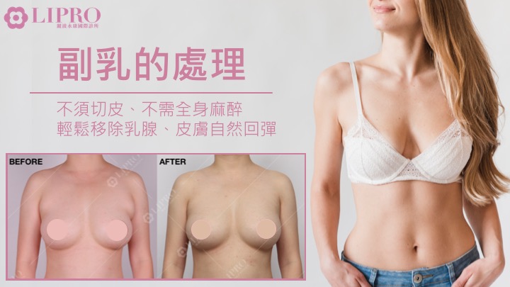  副乳怎麼消,快速消副乳dcard,副乳按摩,副乳運動,副乳內衣,副乳怎麼消dcard