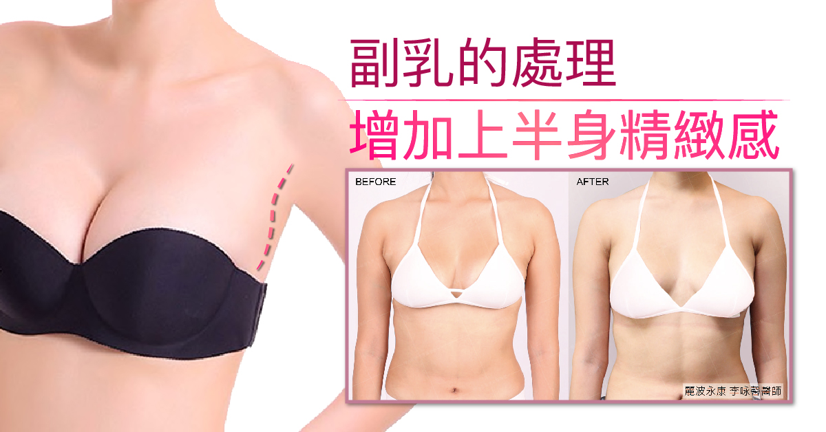  副乳怎麼消,快速消副乳dcard,副乳按摩,副乳運動,副乳內衣,副乳怎麼消dcard