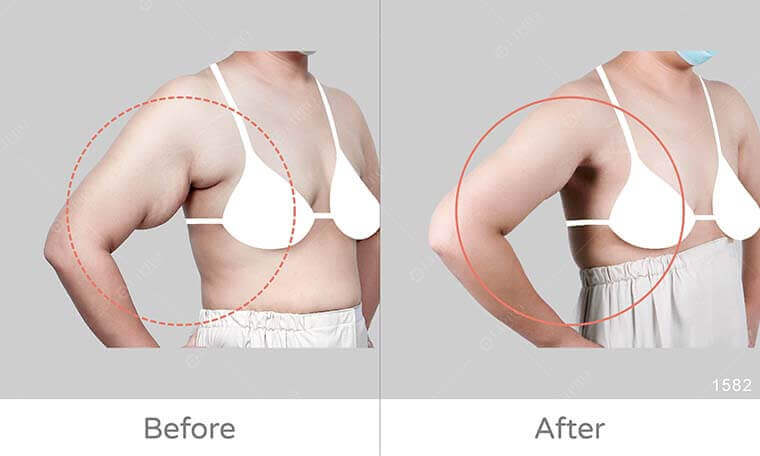副乳怎麼消,快速消副乳dcard,副乳按摩,副乳運動,副乳內衣,副乳怎麼消dcard