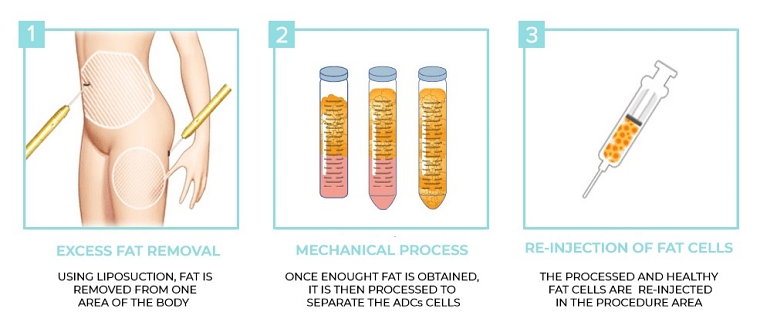 大陰脣補脂,私密處緊實,陰唇手術,大陰脣手術