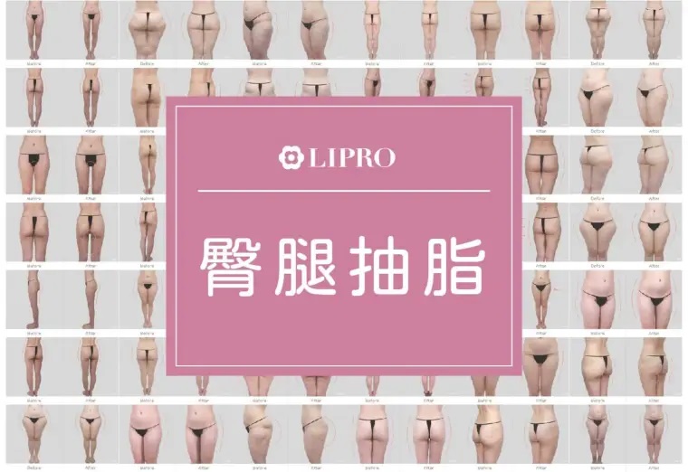 微笑線,臀部,臀部抽脂,豐臀手術