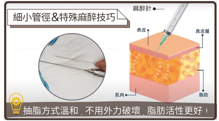 微笑線,臀部,臀部抽脂,豐臀手術