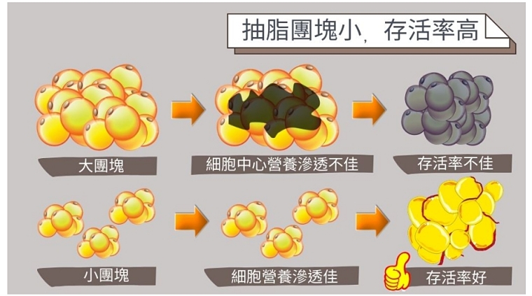 微笑線,臀部,臀部抽脂,豐臀手術