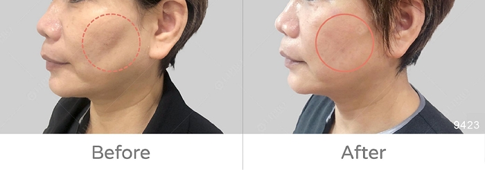 自體脂肪術後保養,手術多久可以喝酒,補脂後悔dcard