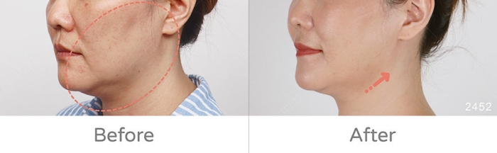 自體脂肪術後保養,手術多久可以喝酒,補脂後悔dcard