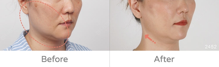 自體脂肪術後保養,手術多久可以喝酒,補脂後悔dcard