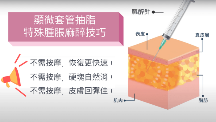 抽脂後遺症ptt,抽脂後遺症,大腿抽脂後遺症,麗波永康國際診所
