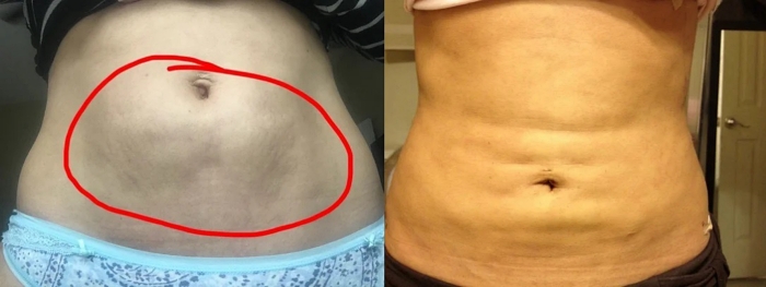 抽脂後遺症ptt,抽脂後遺症,大腿抽脂後遺症,麗波永康國際診所