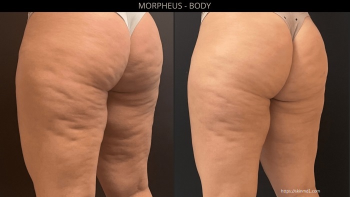 減肥後皮膚鬆弛怎麼辦?體雕缺點