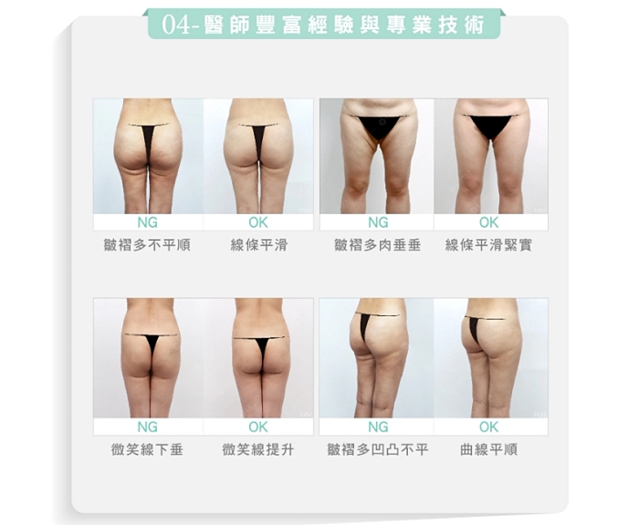 抽脂後遺症ptt,抽脂後遺症,大腿抽脂後遺症,麗波永康國際診所