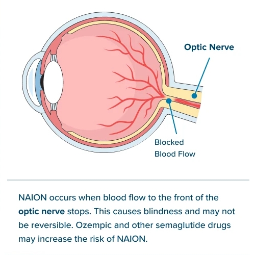 猛健樂視力模糊,猛健樂眼中風,猛健樂失明,猛健樂視力副作用,猛健樂視力模糊dcard